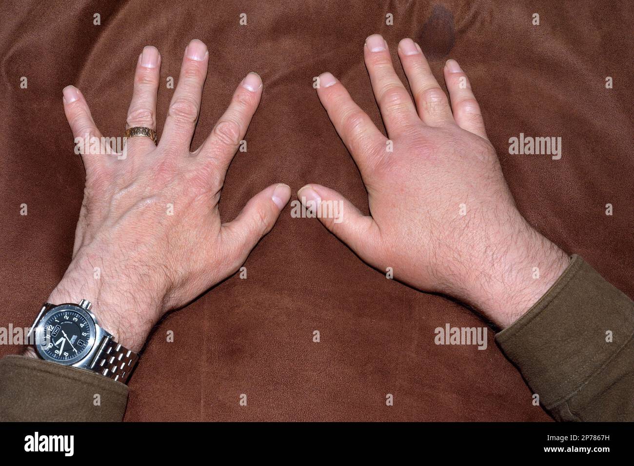 Morso sommatore (Vipera berus) che mostra il confronto delle mani dopo essere stato morso da un sommatore con gonfiore sulla mano destra, Northumberland, Inghilterra, maggio 2015 Foto Stock
