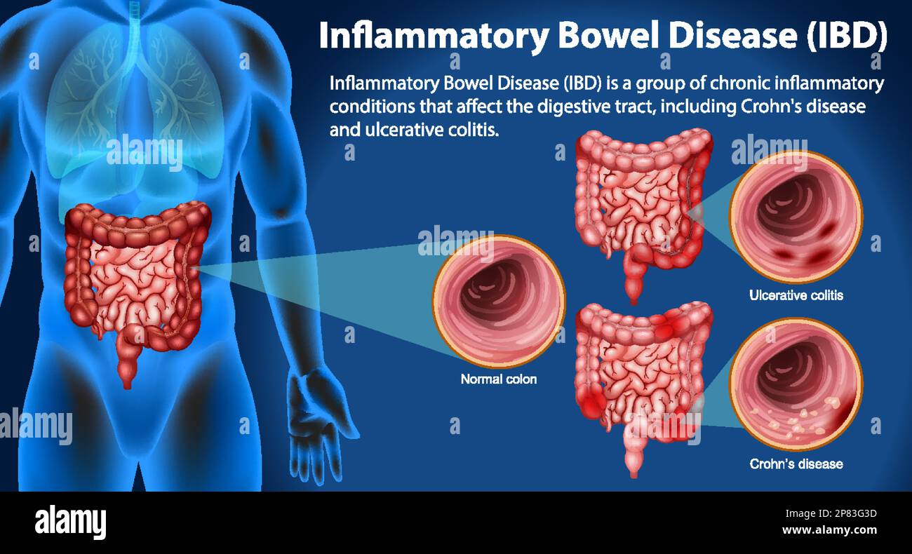 Infografica sulla malattia infiammatoria intestinale (IBD) Illustrazione Vettoriale