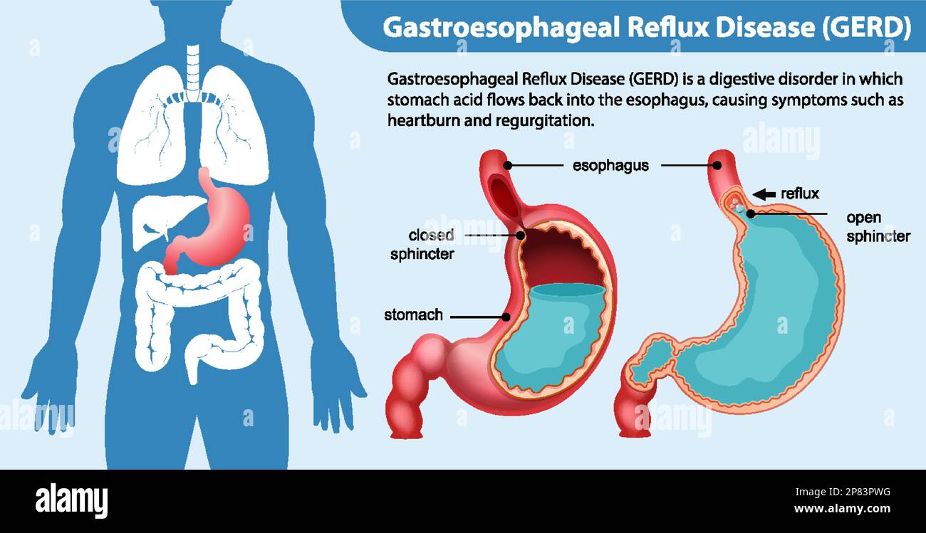 Malattia da reflusso gastroesofageo (GERD) illustrazione del diagramma Illustrazione Vettoriale