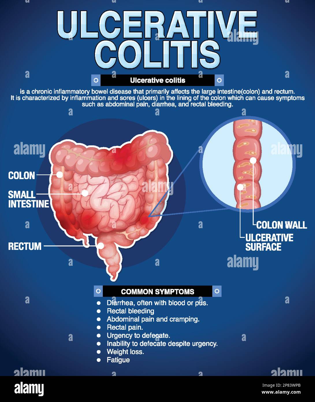 Sintomi della colite ulcerosa illustrazione infografica Illustrazione Vettoriale