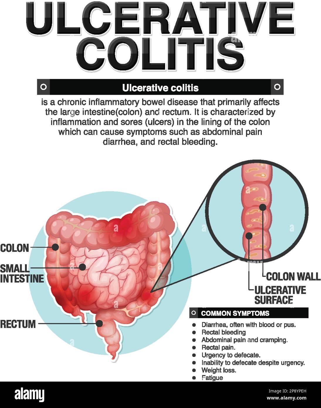 Sintomi della colite ulcerosa illustrazione infografica Illustrazione Vettoriale