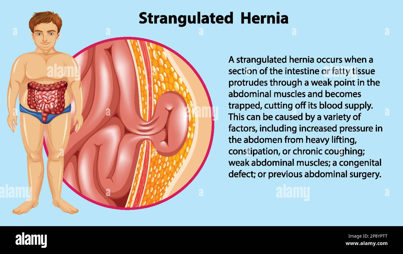 Cause dell'ernia strangolata illustrazione infografica Illustrazione Vettoriale