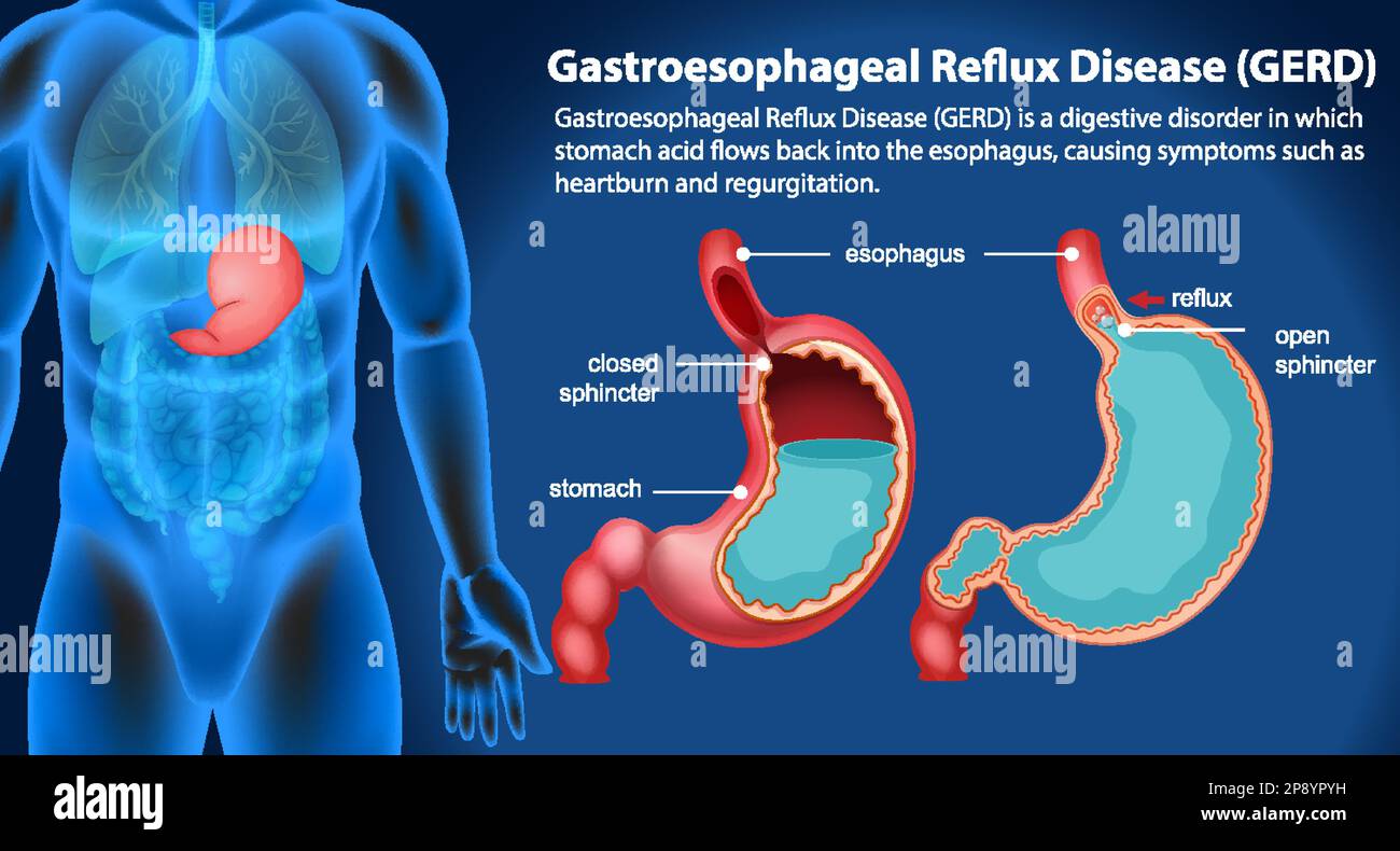 Malattia da reflusso gastroesofageo (GERD) illustrazione del diagramma Illustrazione Vettoriale