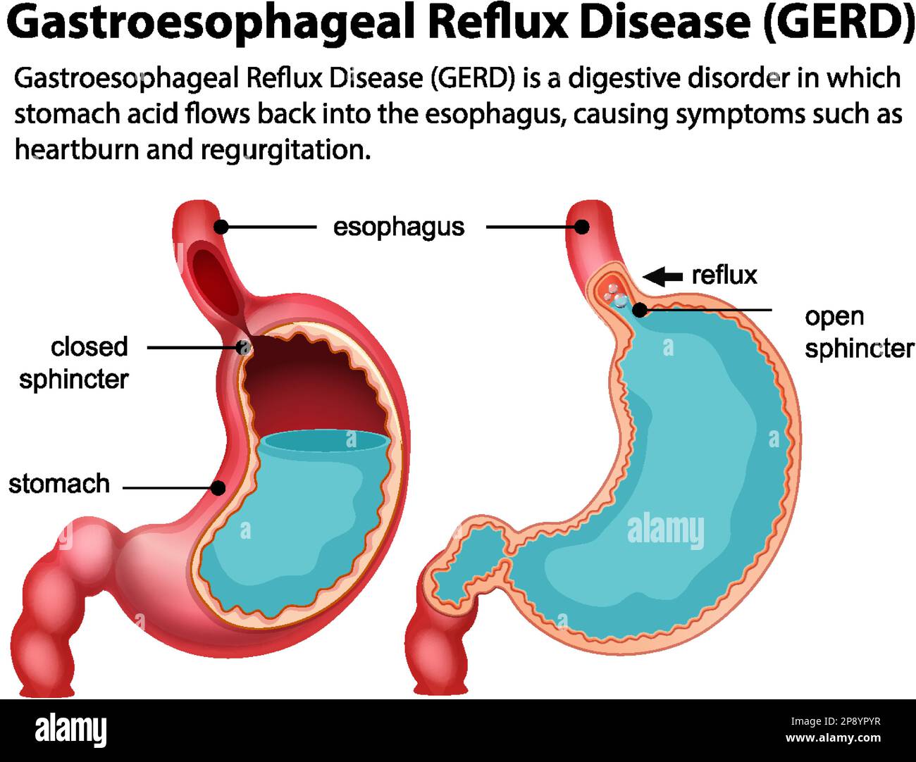 Malattia da reflusso gastroesofageo (GERD) illustrazione del diagramma Illustrazione Vettoriale