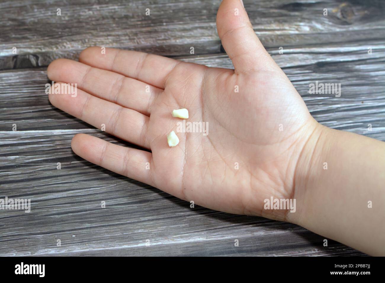 Denti temporanei decidui del bambino primario, la prima serie di denti nella crescita e lo sviluppo degli esseri umani, sono di solito persi e sostituiti da permanen Foto Stock