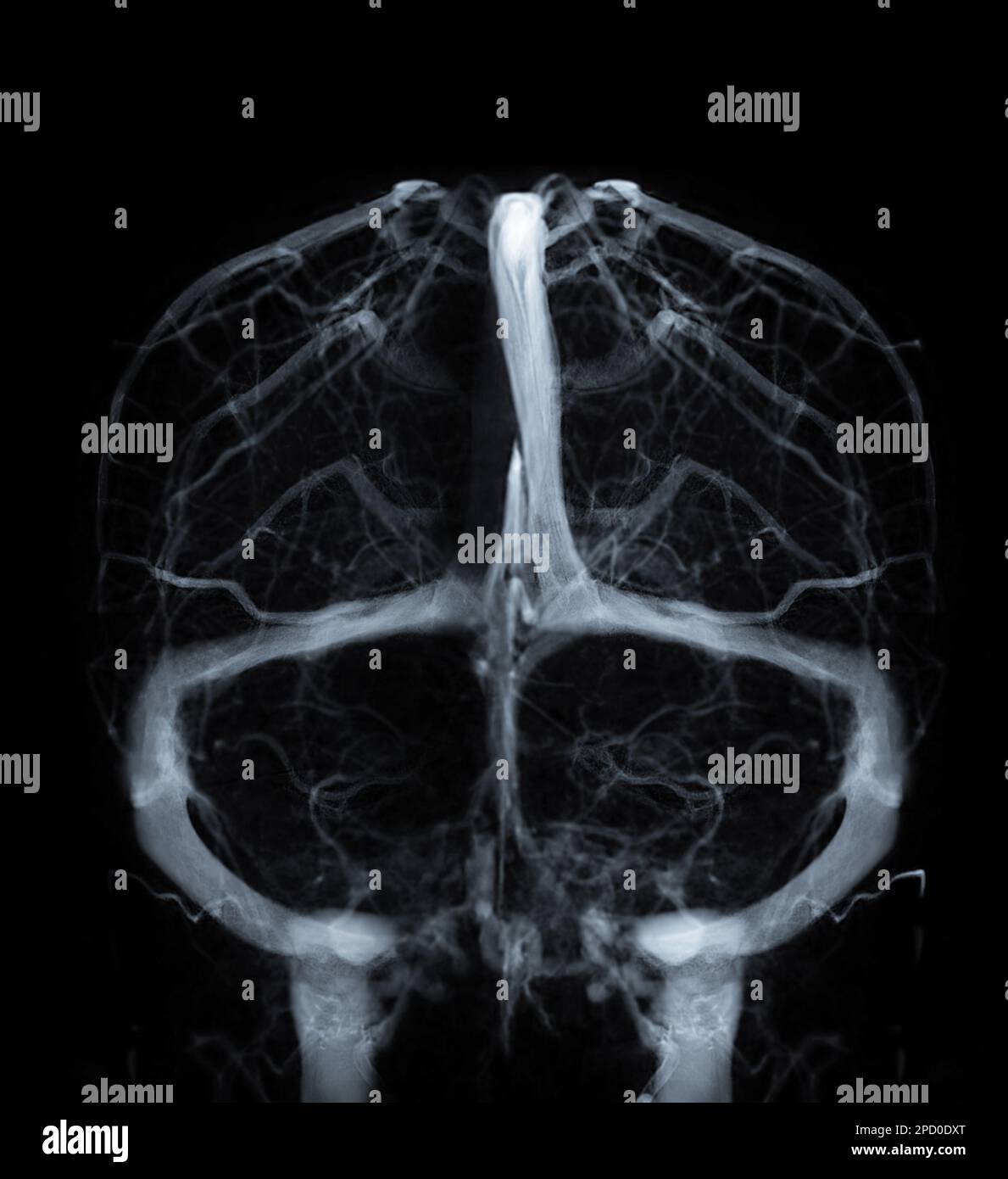 Venografia cerebrale per diagnosi trombosi venosa cerebrale Foto Stock