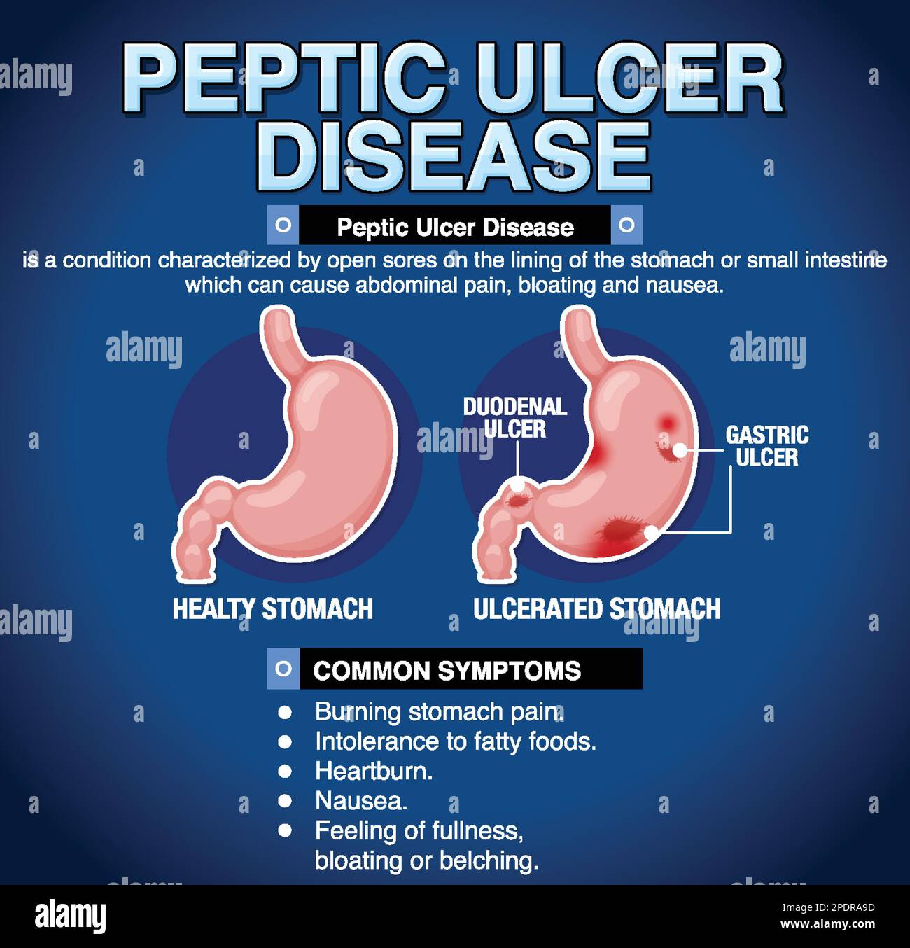 La malattia dell'ulcera peptica ha spiegato l'illustrazione infografica Illustrazione Vettoriale