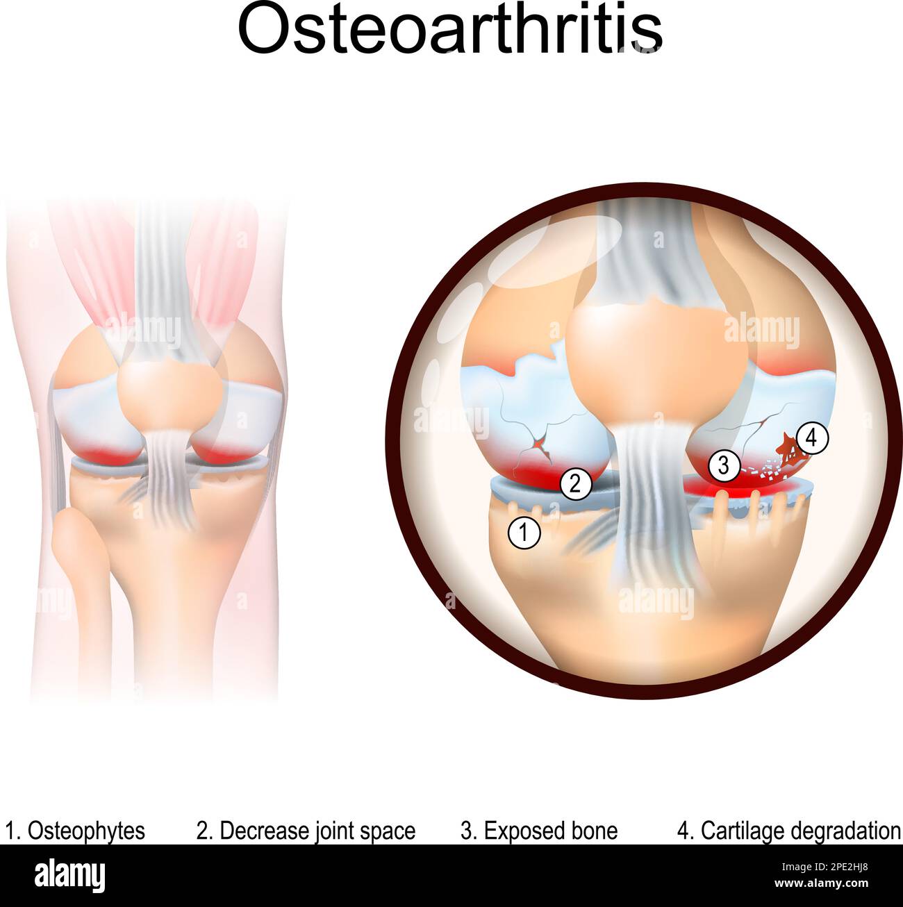Osteoartrite. Gamba umana con infiammazione del ginocchio. Primo piano dell'articolazione del ginocchio con sintomi dell'artrite: Degradazione della cartilagine, osso esposto Illustrazione Vettoriale