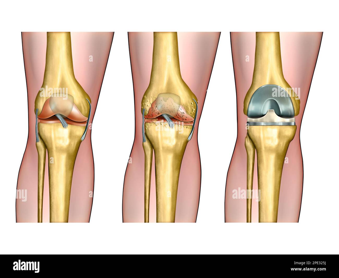 Anatomia sana del ginocchio, artrite degenerativa del ginocchio e chirurgia sostitutiva. Illustrazione digitale. Foto Stock