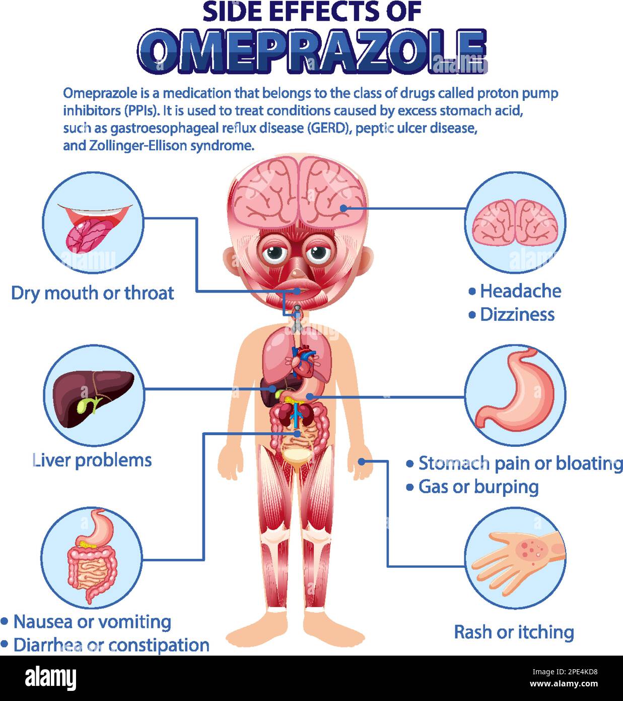 Diagramma anatomico umano stile cartone animato di Omeprazolo effetti collaterali illustrazione Illustrazione Vettoriale