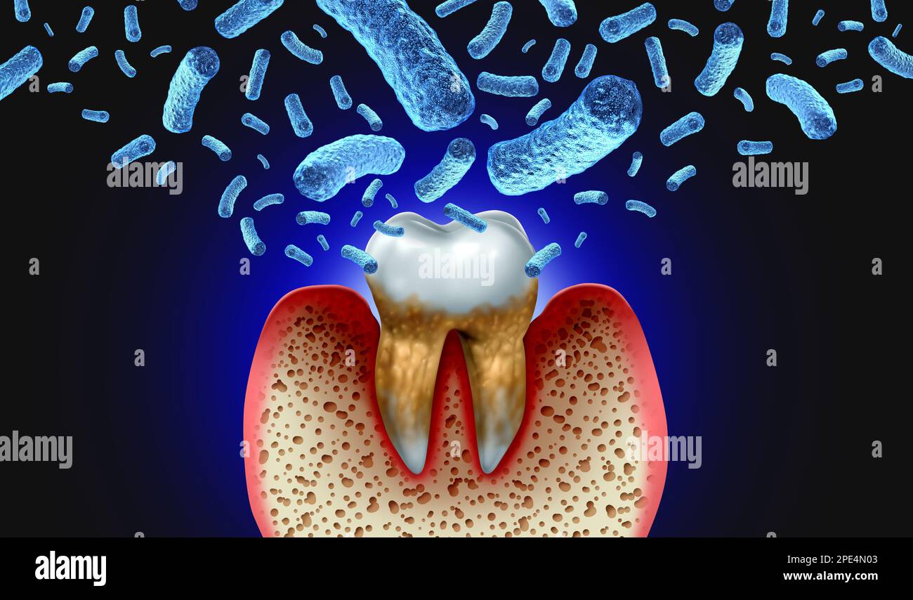 Infezione batterica dei denti e malattia di decadimento dei denti come un molare malsano con periodontite a causa di scarsa igiene orale salute come un batterio infettivo Foto Stock
