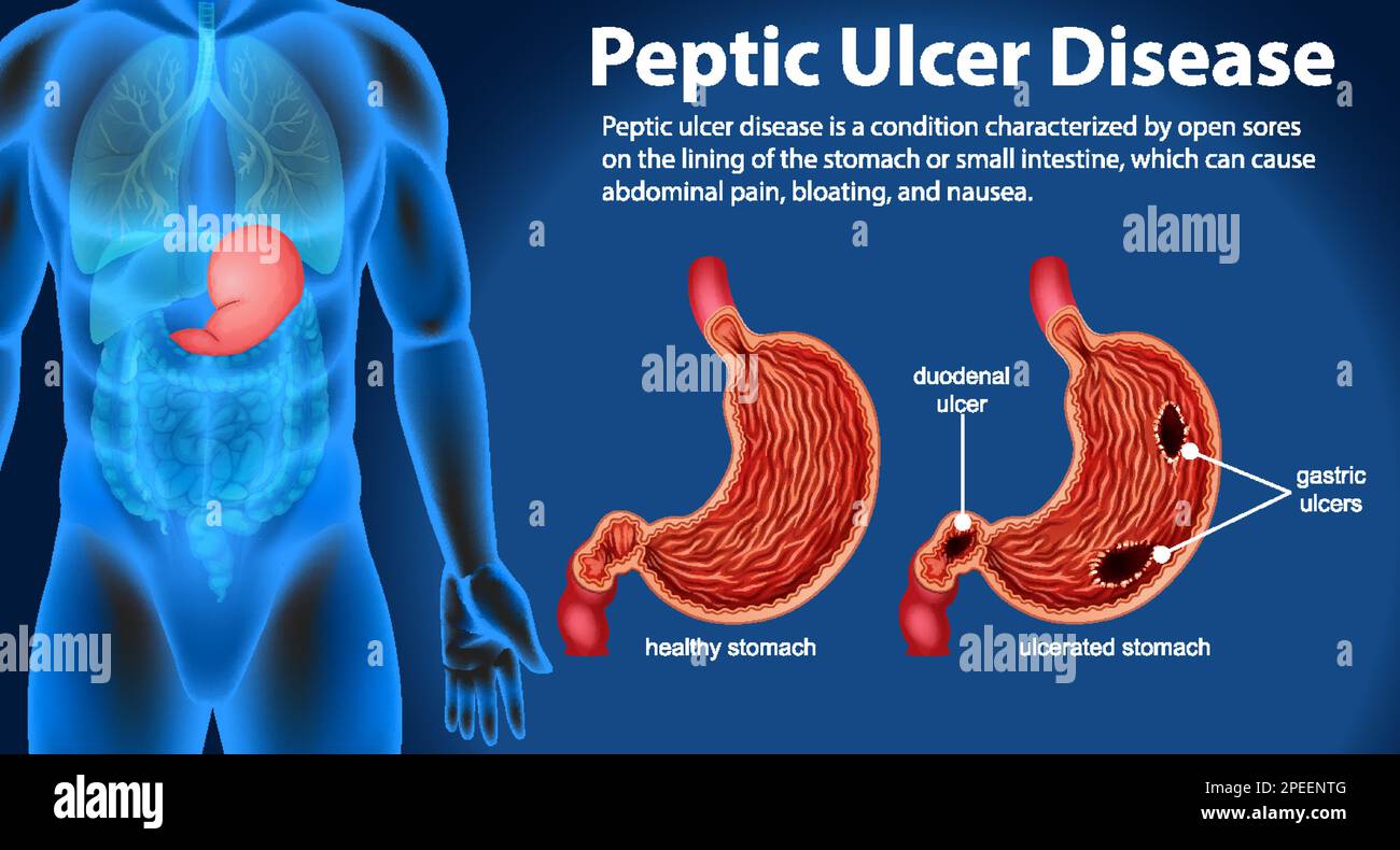 Ulcera peptica illustrazione infografica Illustrazione Vettoriale