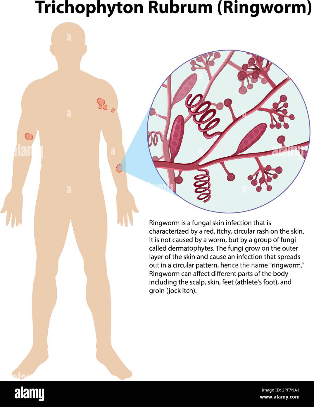 Trichophyton rubrum infezione fungal illustrazione Illustrazione Vettoriale