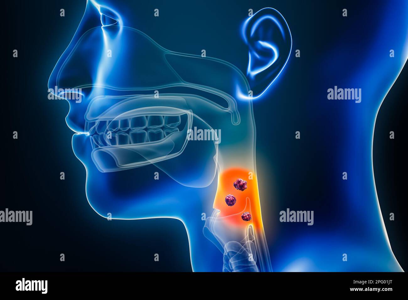 Laryngofaringe o cancro alla gola con organi e tumori o cellule cancerose 3D che rendono illustrazione. Anatomia, oncologia, faringe malattia, medico, biol Foto Stock