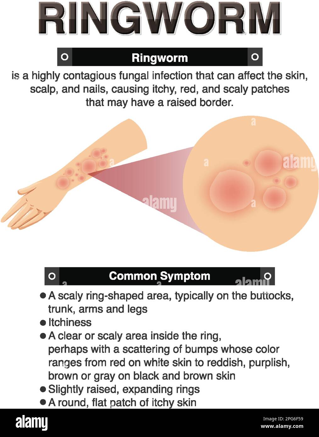 Sintomi informativi di Ringworm illustrazione Illustrazione Vettoriale