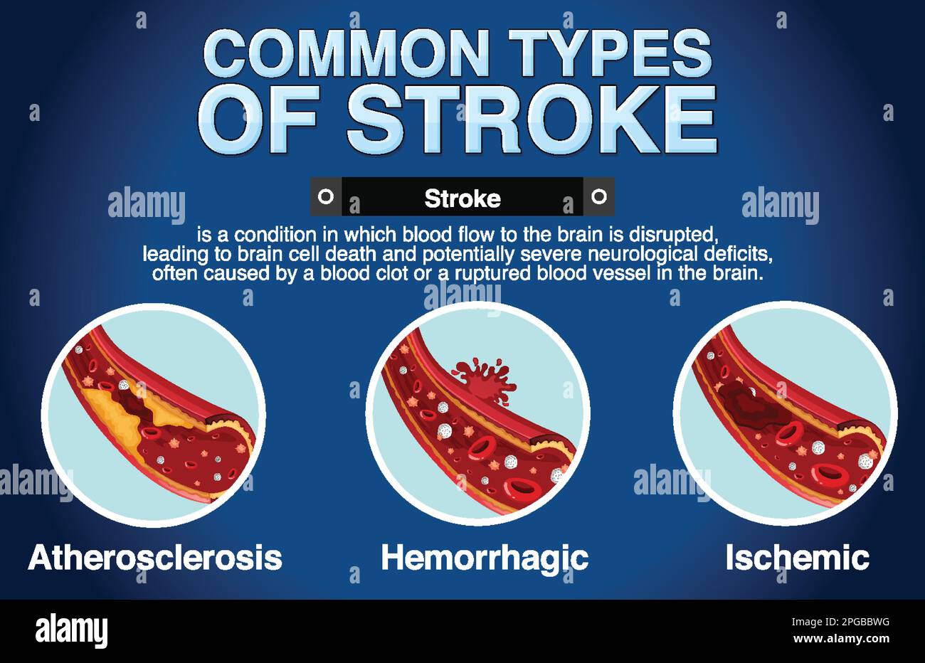 Poster informativo dei tipi più comuni di illustrazione stoke Illustrazione Vettoriale