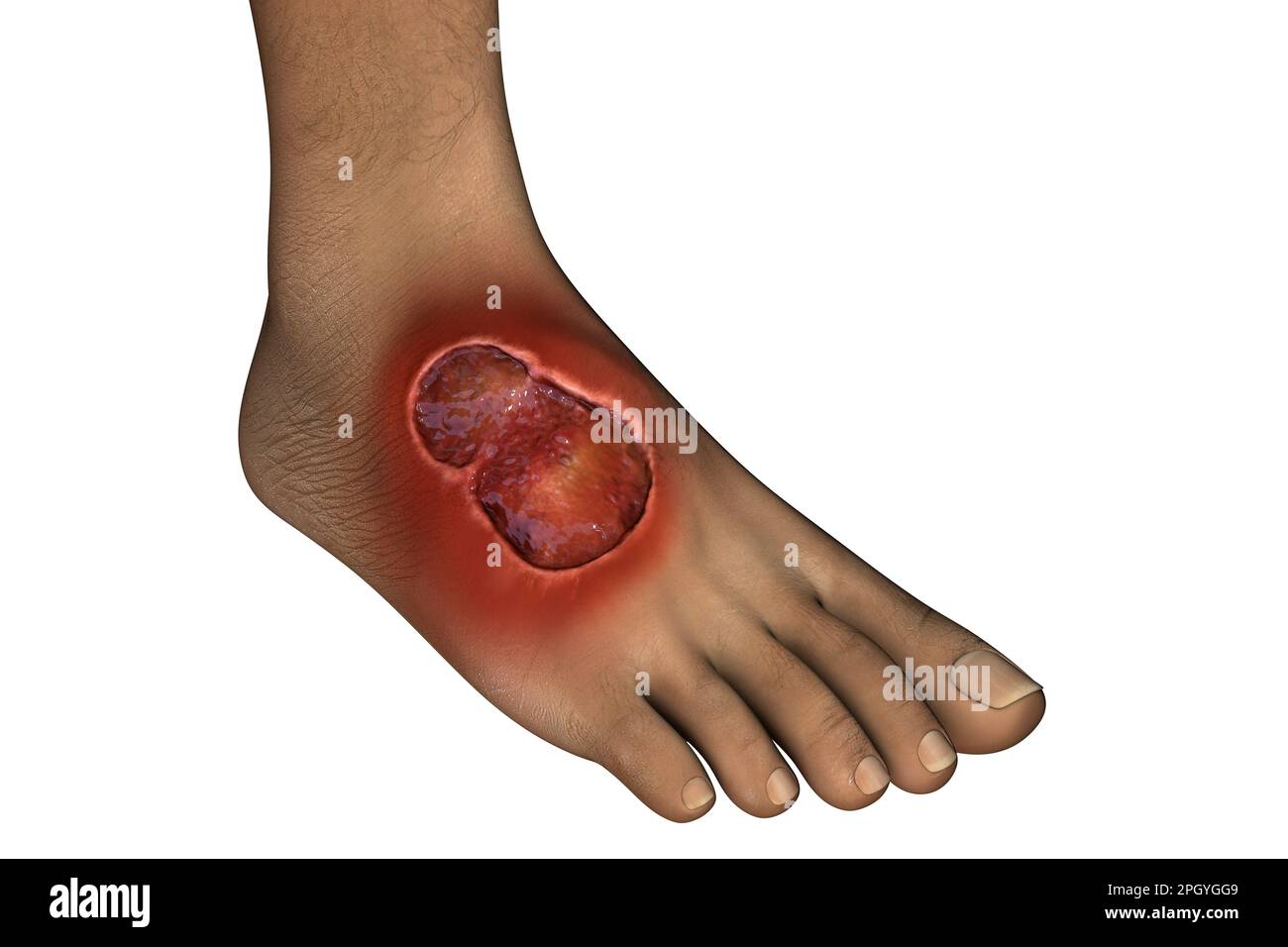 Ulcera di Buruli su un piede, illustrazione Foto Stock