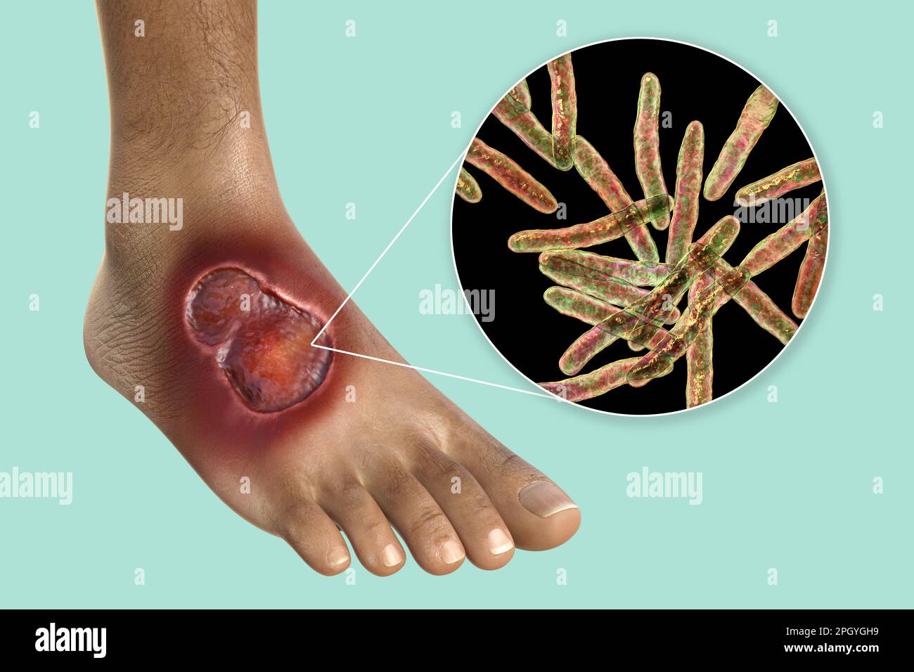 Ulcera di Buruli e Mycobacterium ulcerans, illustrazione Foto Stock