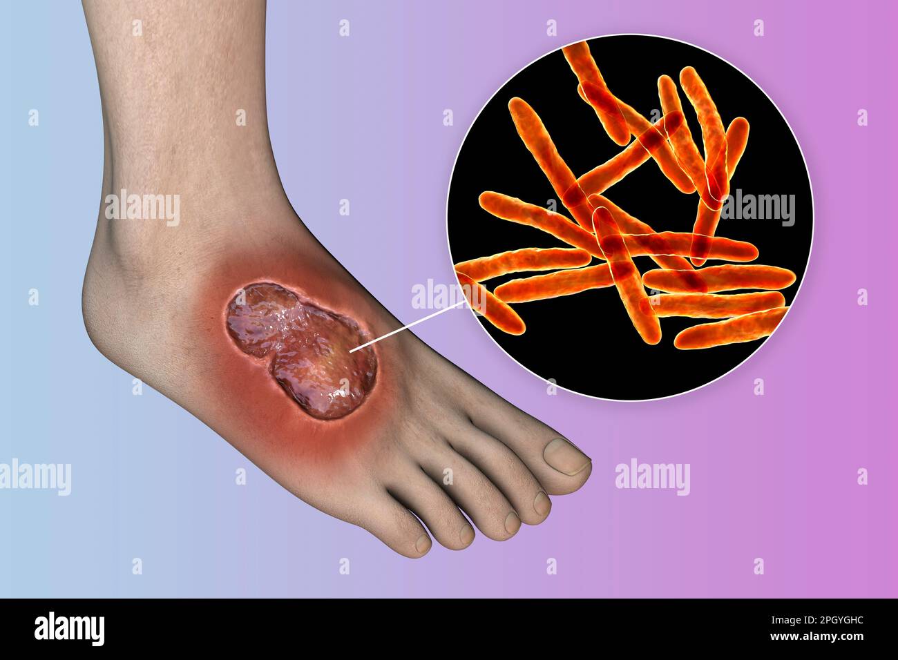 Ulcera di Buruli e Mycobacterium ulcerans, illustrazione Foto Stock