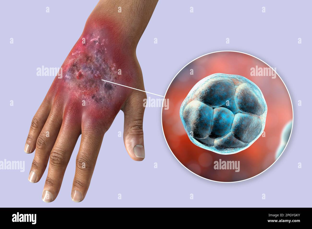 Infezione da prototecosi su una mano umana, illustrazione Foto Stock
