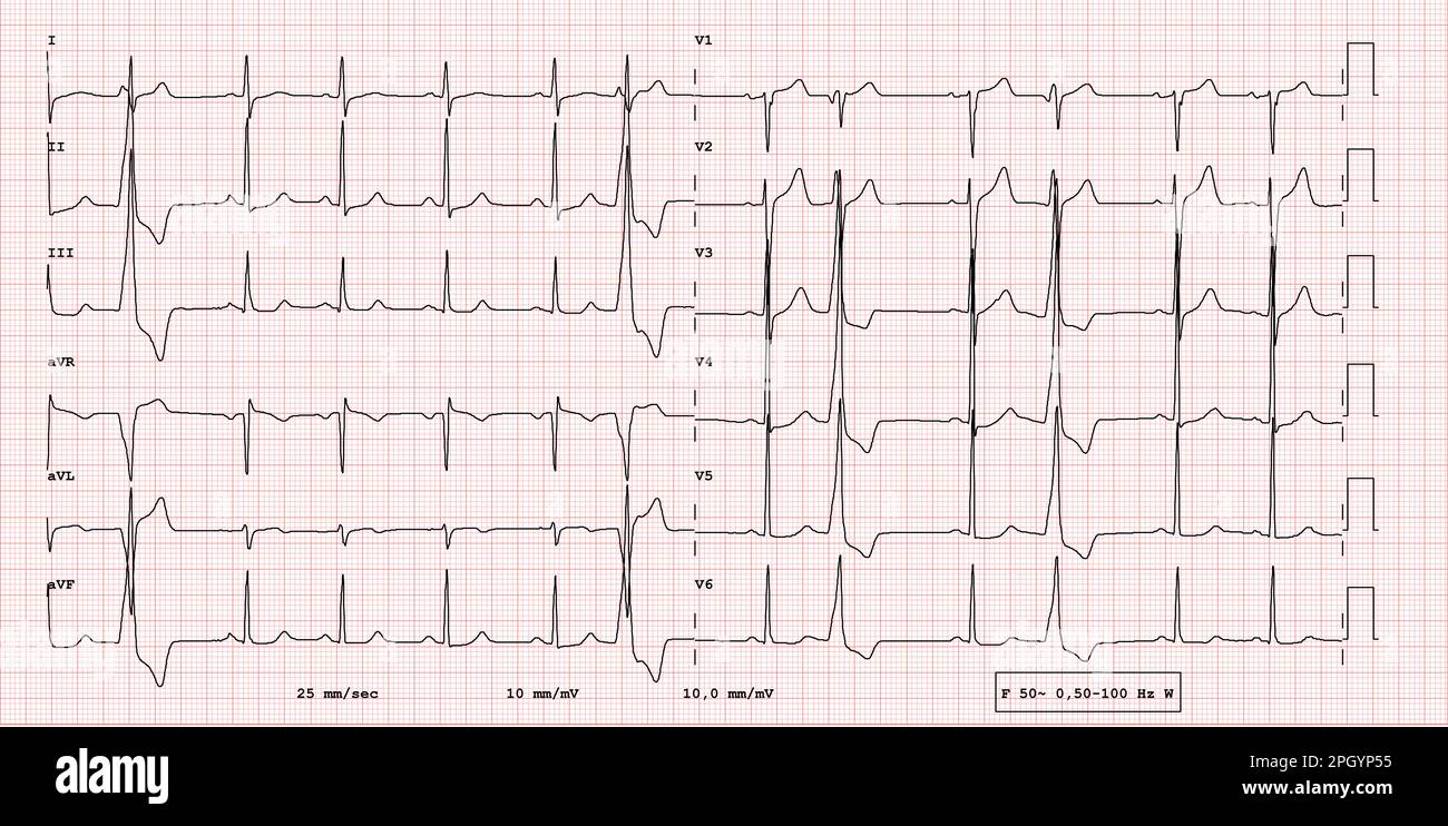 Esempio ECG di ritmo a 12 derivazioni, Bigeminismo ventricolare, esame reale Foto Stock