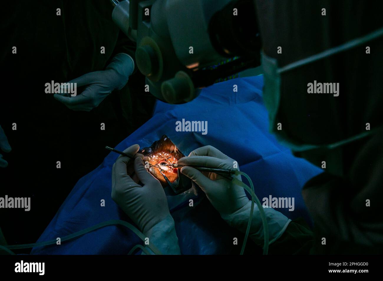 BOGOR, INDONESIA - 27 marzo 2023: I medici effettuano la chirurgia dell'occhio di cataratta sui pazienti usando la tecnica di facoemulsificazione a Bogor, Indonesia Foto Stock