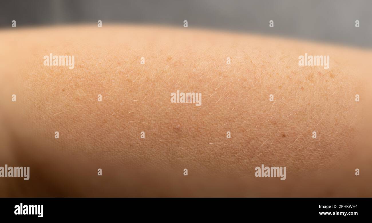 Closeup talpa della pelle. Macro foto di macchia simile al melanoma, nevo marrone, piccolo segno di nascita, macchia sulla pelle umana Foto Stock