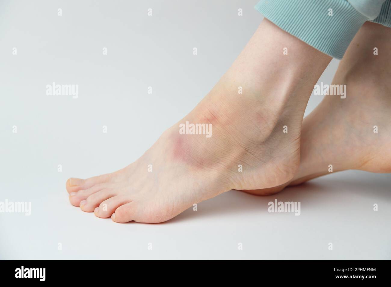 Sprained ankle immagini e fotografie stock ad alta risoluzione - Alamy