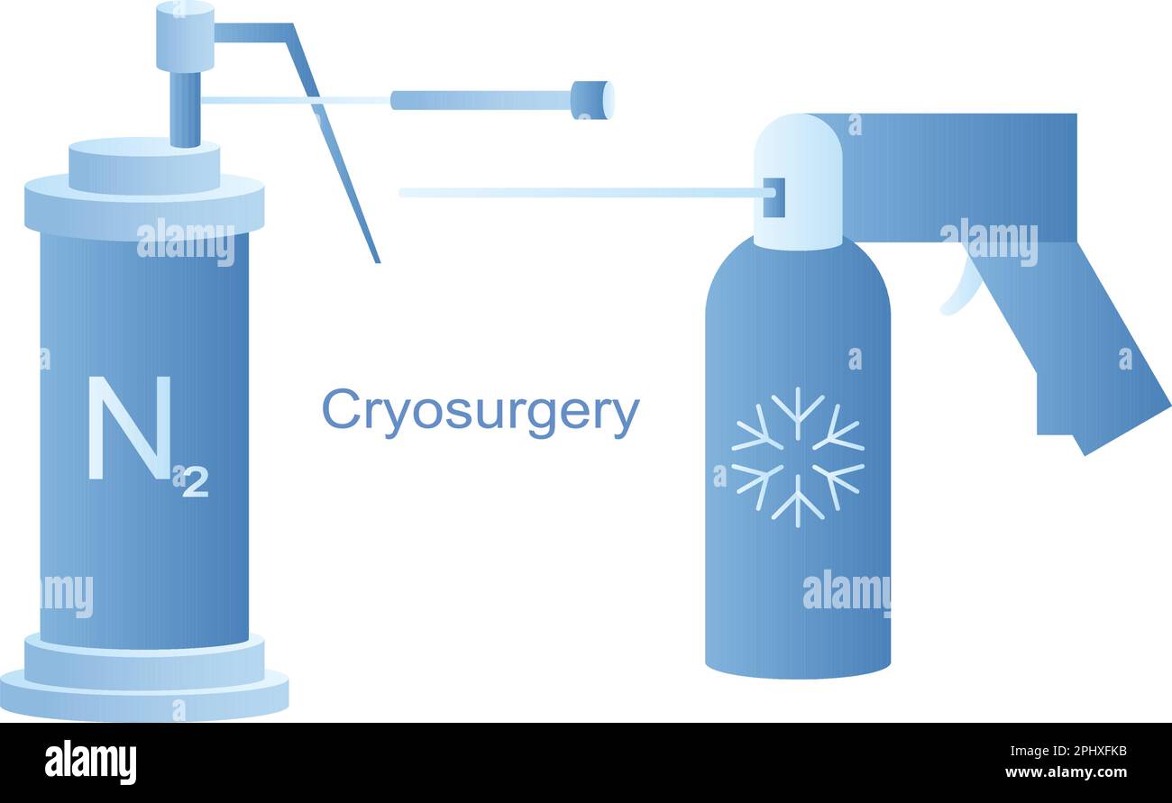 Strumenti criogenici per criochirurgia con linee vettoriali. Raffreddamento ad azoto liquido per trattamento criogenico. Terapia con ghiaccio per lesioni benigne e maligne. Illustrazione Vettoriale