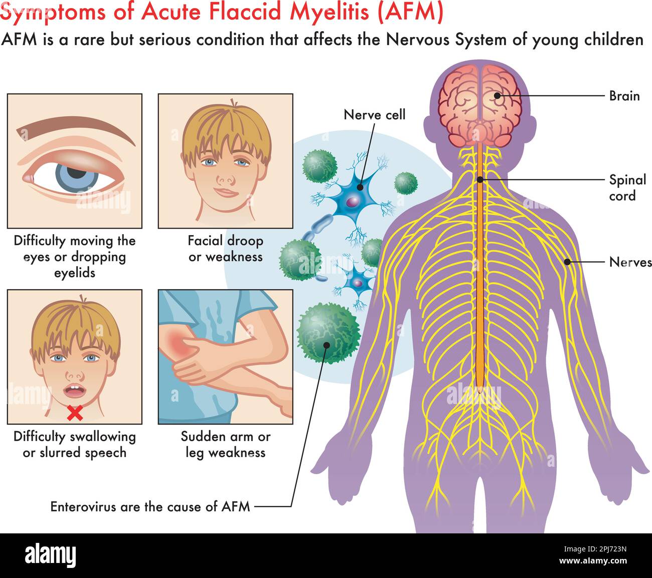 Illustrazione medica dei sintomi di mielite flaccida acuta (AFM), con annotazioni. Illustrazione Vettoriale