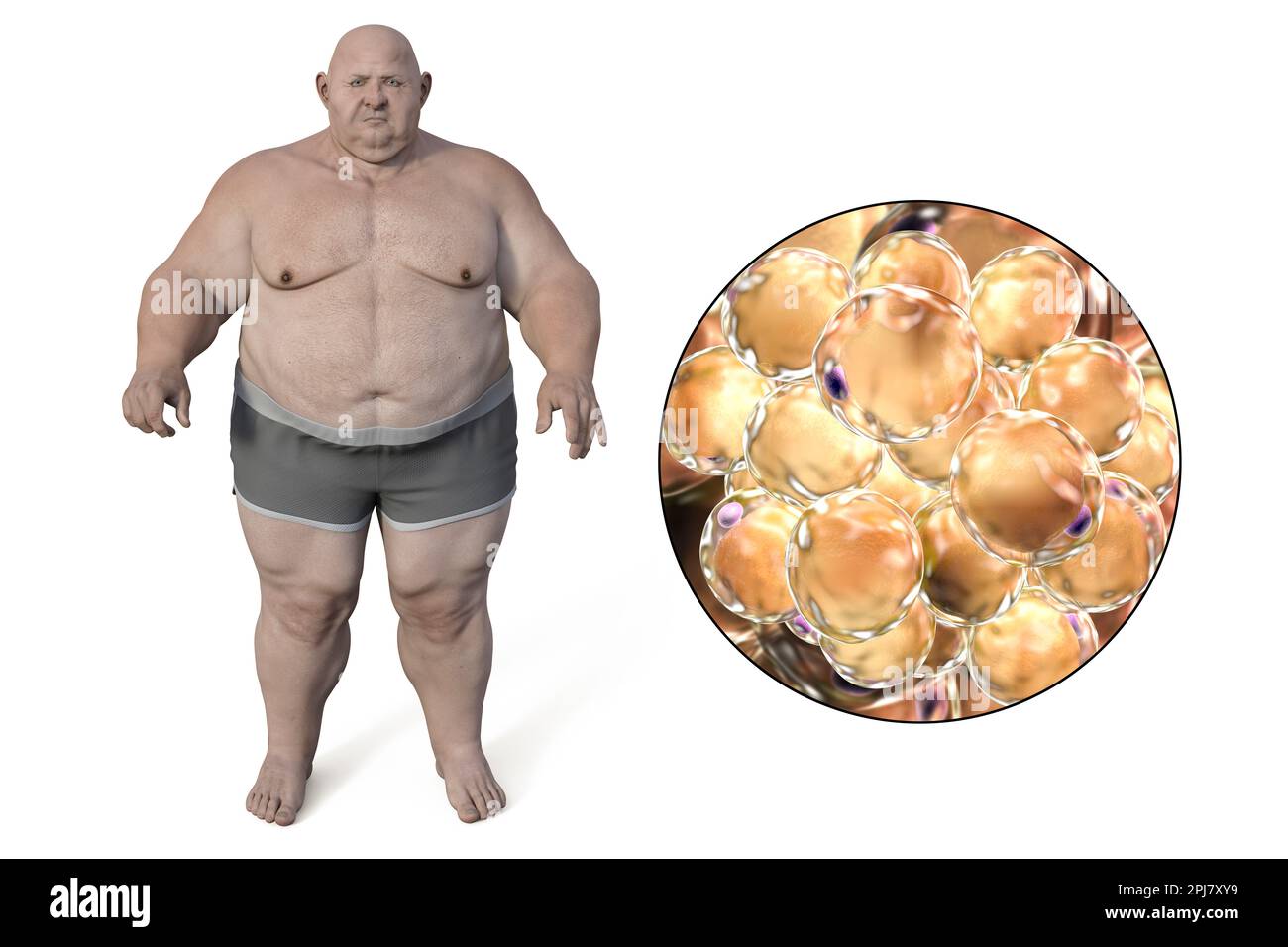 Uomo obeso e cellule grasse, illustrazione Foto Stock