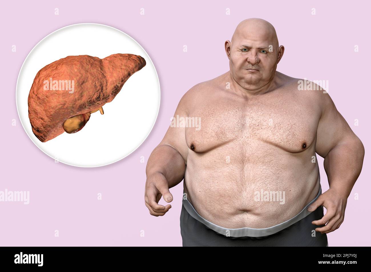 Steatosi epatica in un uomo in sovrappeso, illustrazione Foto Stock