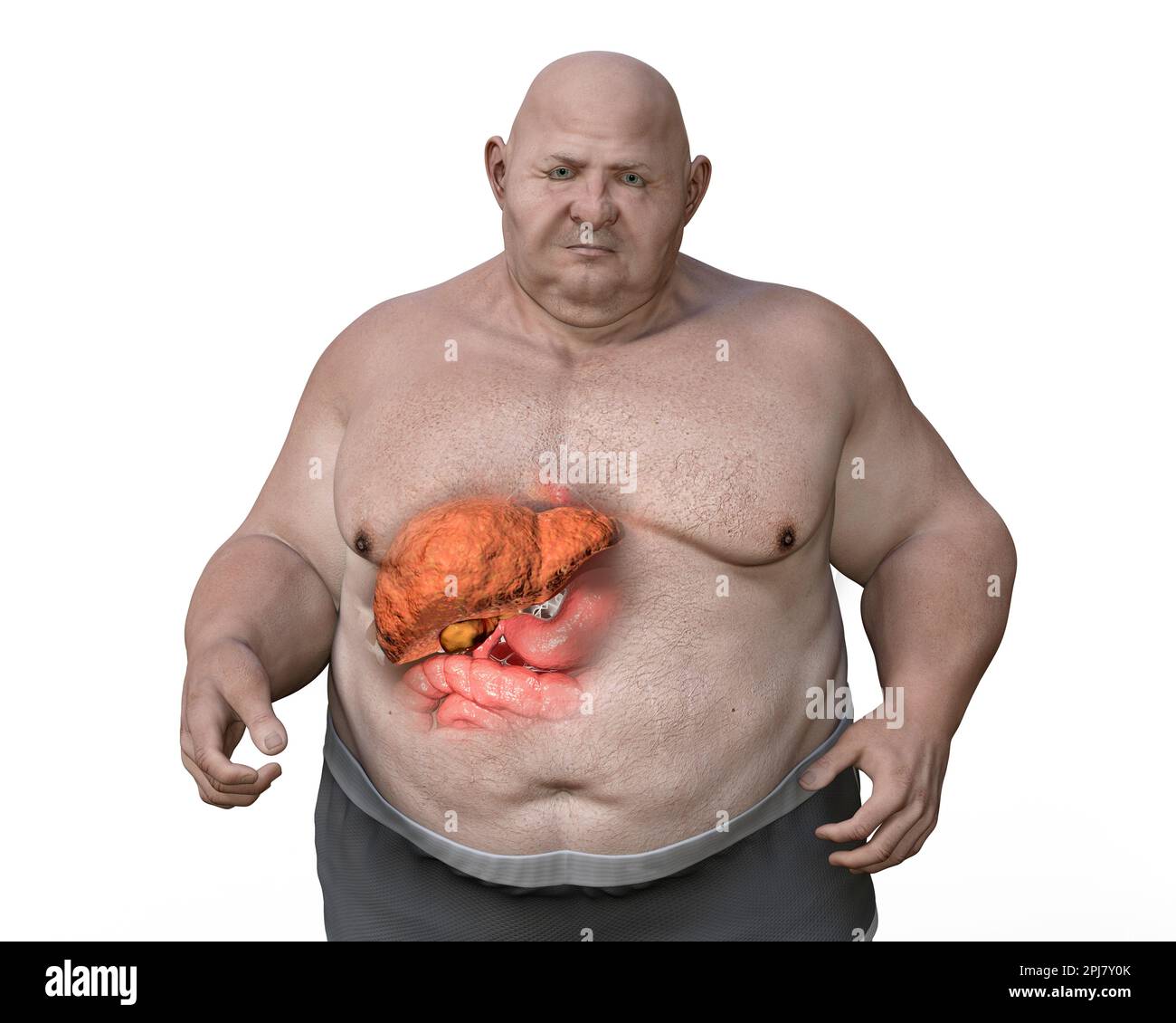 Steatosi epatica in un uomo in sovrappeso, illustrazione Foto Stock