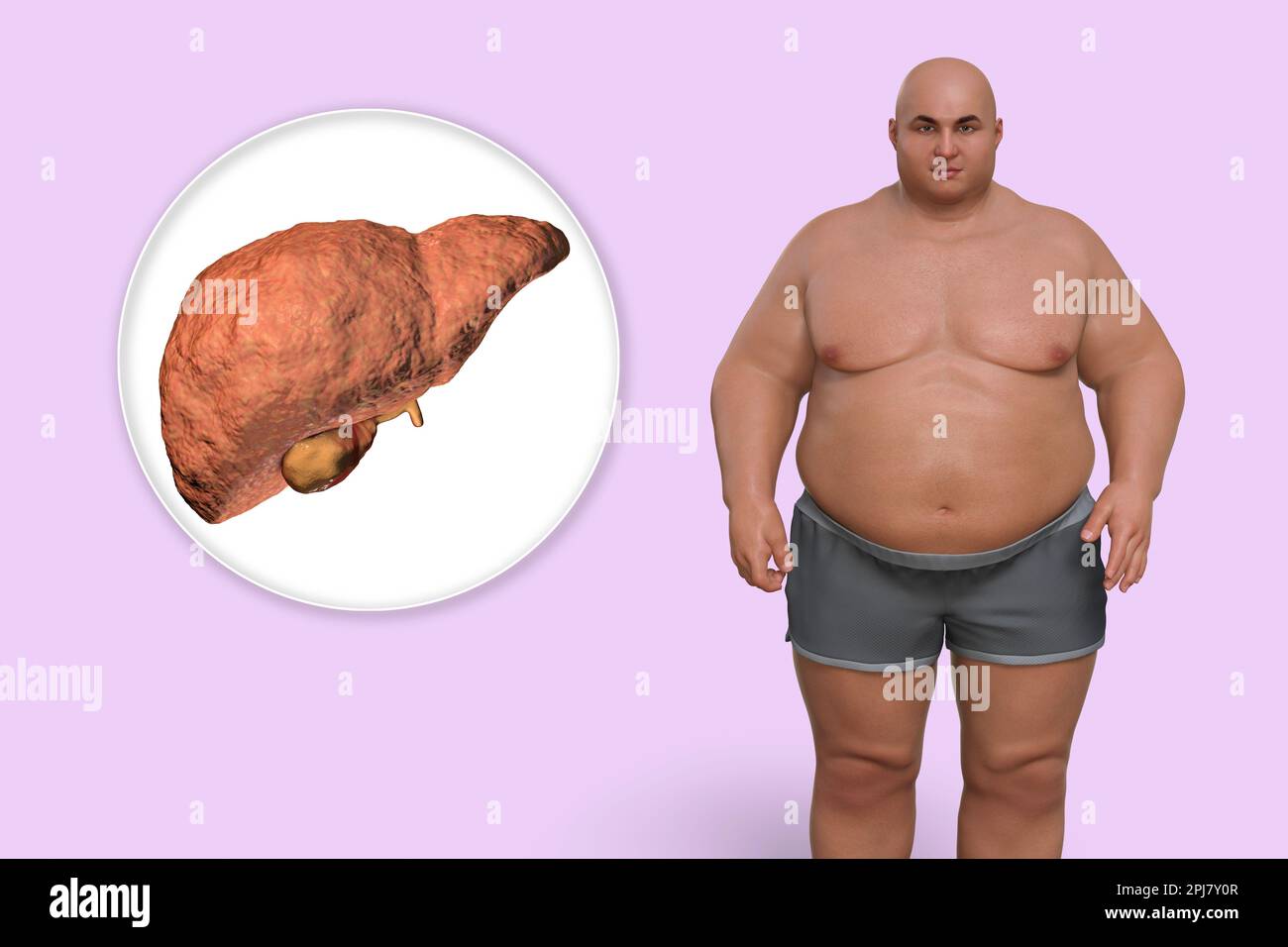 Steatosi epatica in un uomo in sovrappeso, illustrazione Foto Stock