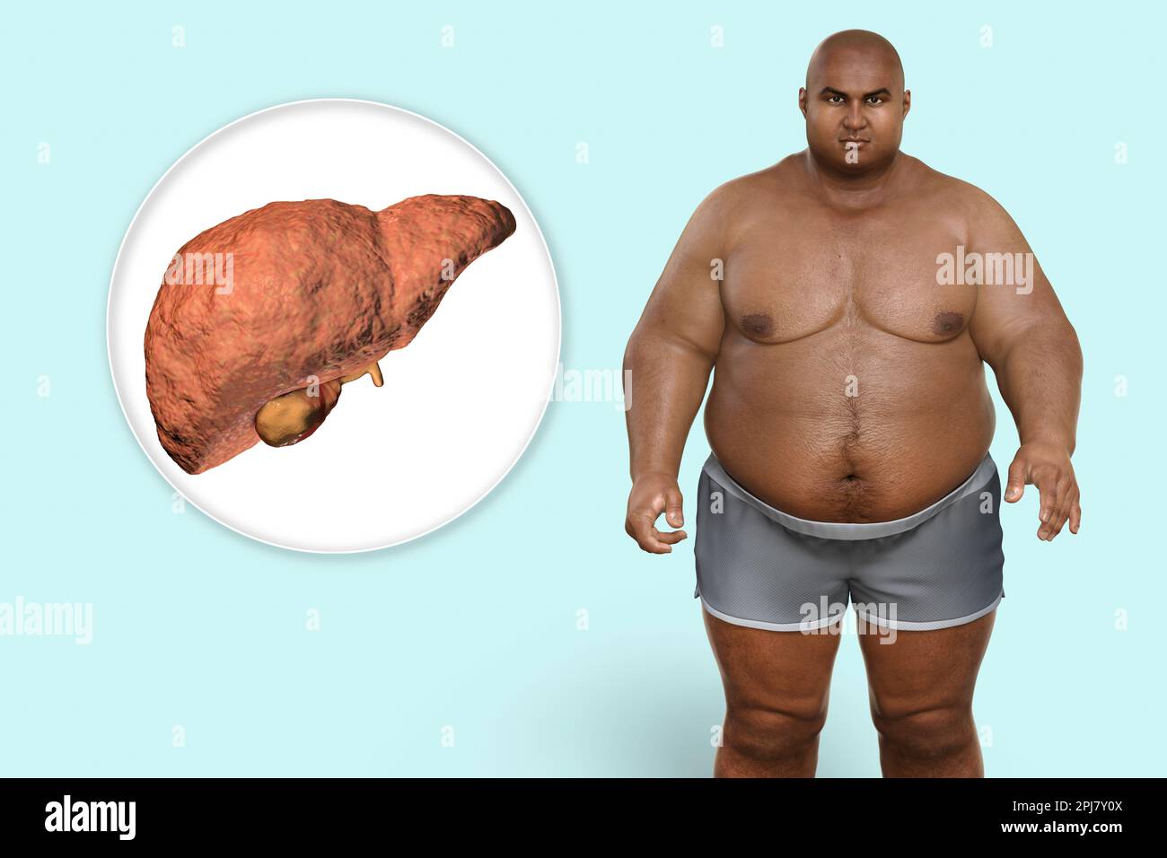 Steatosi epatica in un uomo in sovrappeso, illustrazione Foto Stock