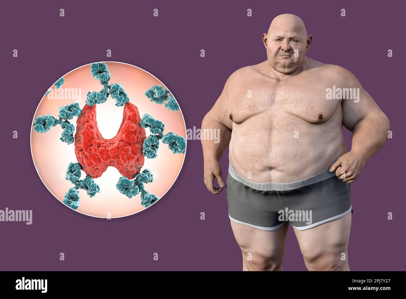 Malattia autoimmune della tiroide e obesità, illustrazione Foto Stock