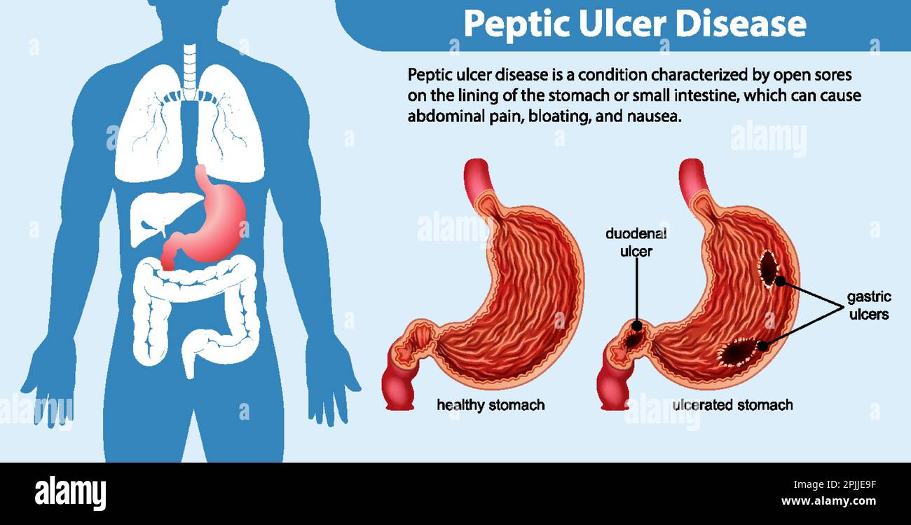 Ulcera peptica illustrazione infografica Illustrazione Vettoriale