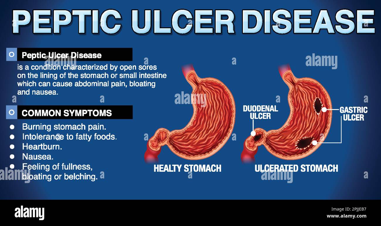 La malattia dell'ulcera peptica ha spiegato l'illustrazione infografica Illustrazione Vettoriale