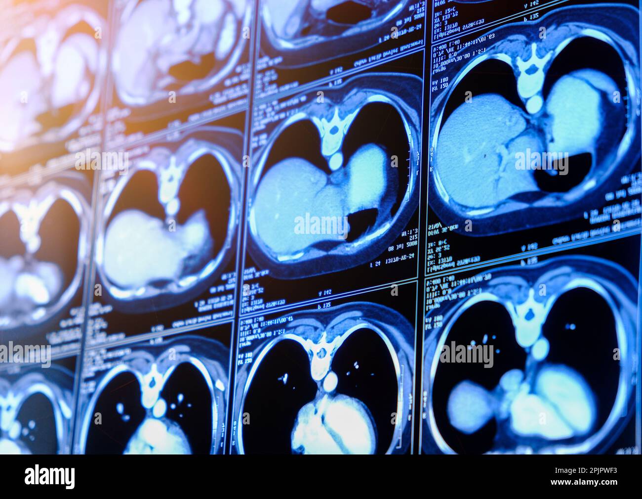 Tomografia computerizzata (TC) del torace. Background medico. Foto monocromatiche Foto Stock