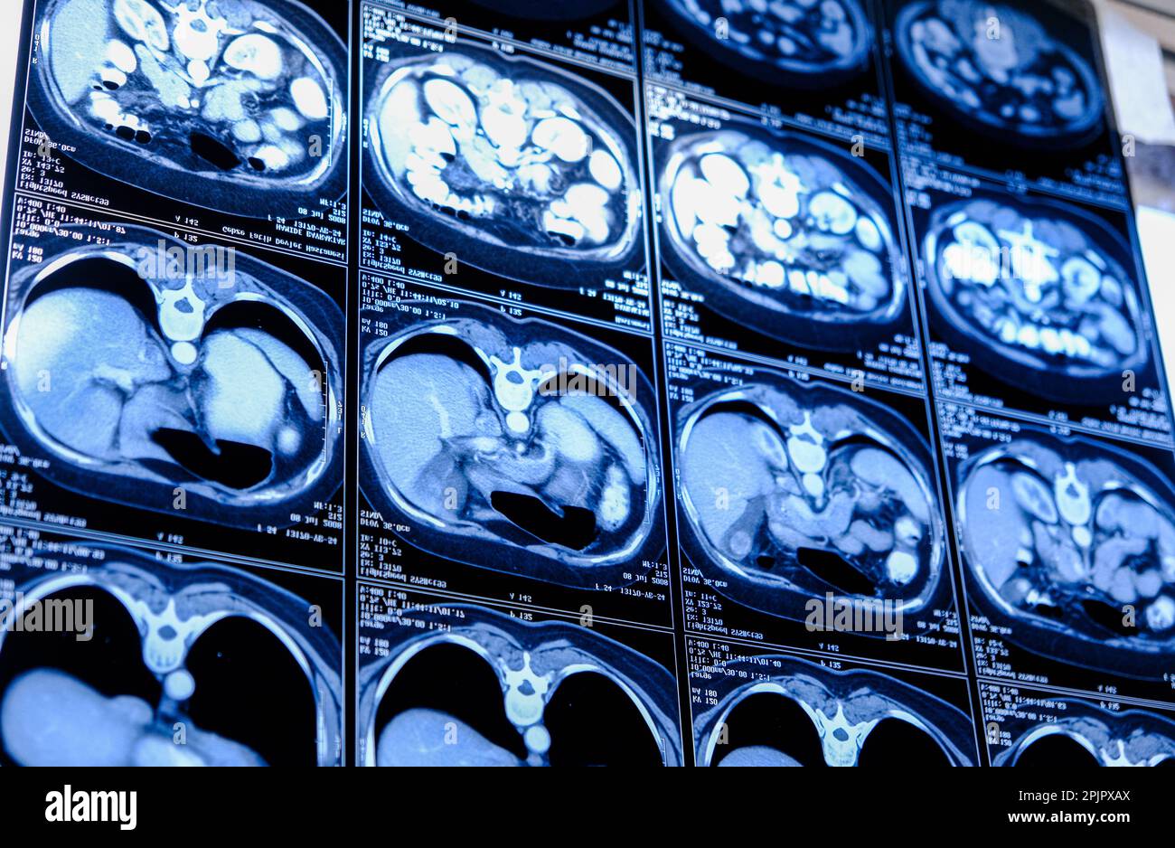 Tomografia computerizzata (TC) del torace. Background medico. Foto monocromatiche Foto Stock