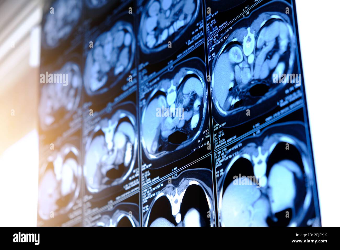 Tomografia computerizzata (TC) del torace. Background medico. Foto monocromatiche Foto Stock