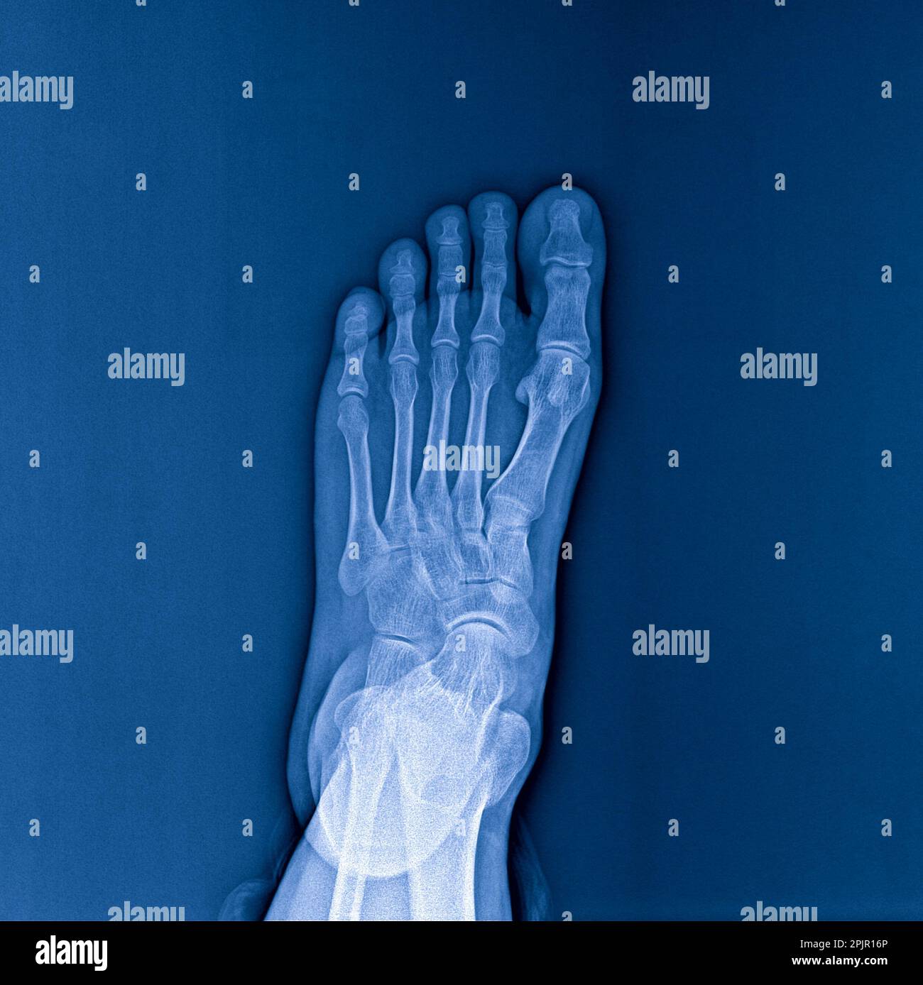 Raggi X del piede su sfondo scuro, radiografia Foto Stock