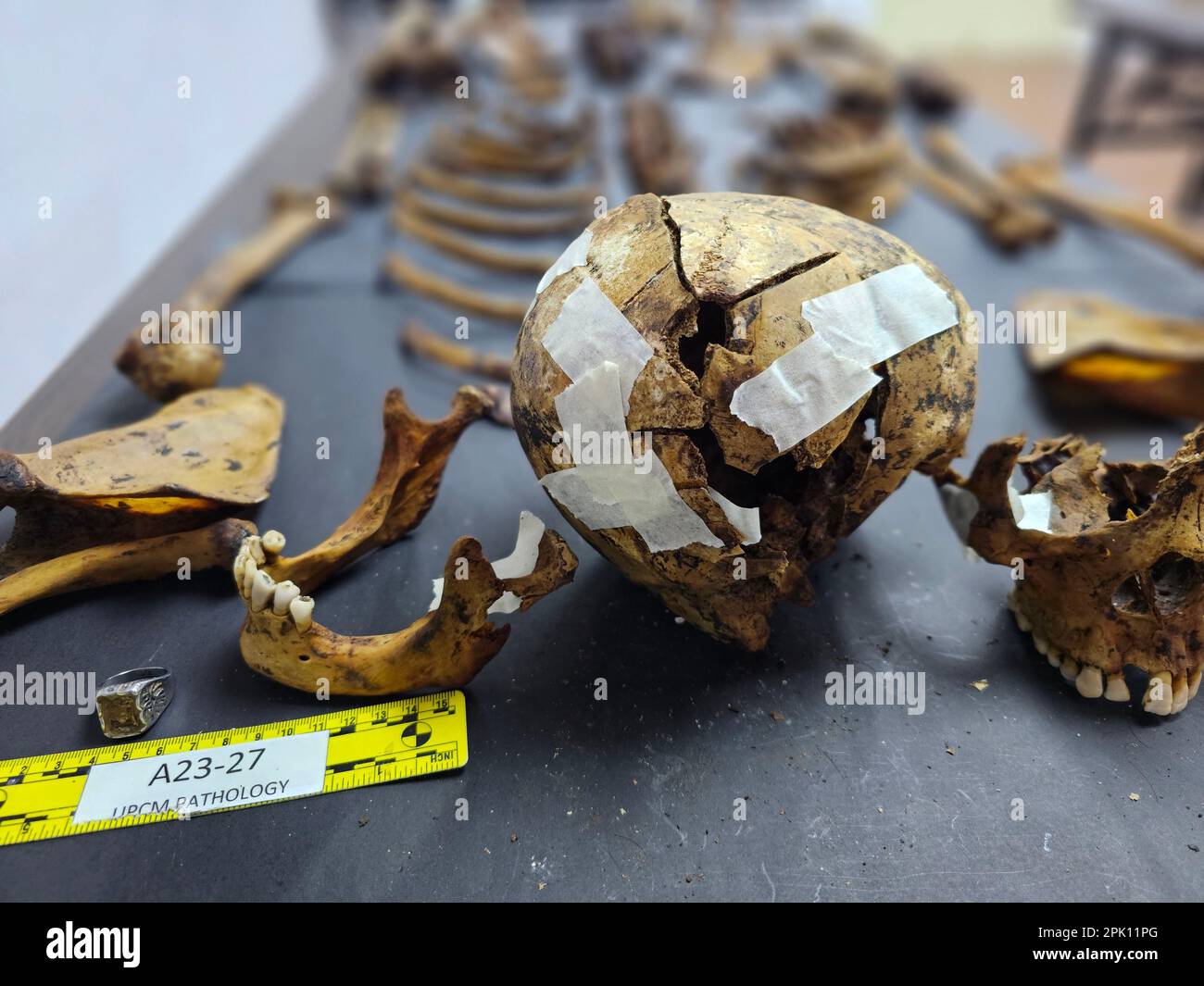 Manila, Filippine. 04th Apr, 2023. Il patologo forense Dr. Raquel Fortun esamina gli scheletri esumati delle vittime della guerra di droga a Caloocan City. (Foto di Sherbien Dacalanio/Pacific Press) Credit: Pacific Press Media Production Corp./Alamy Live News Foto Stock