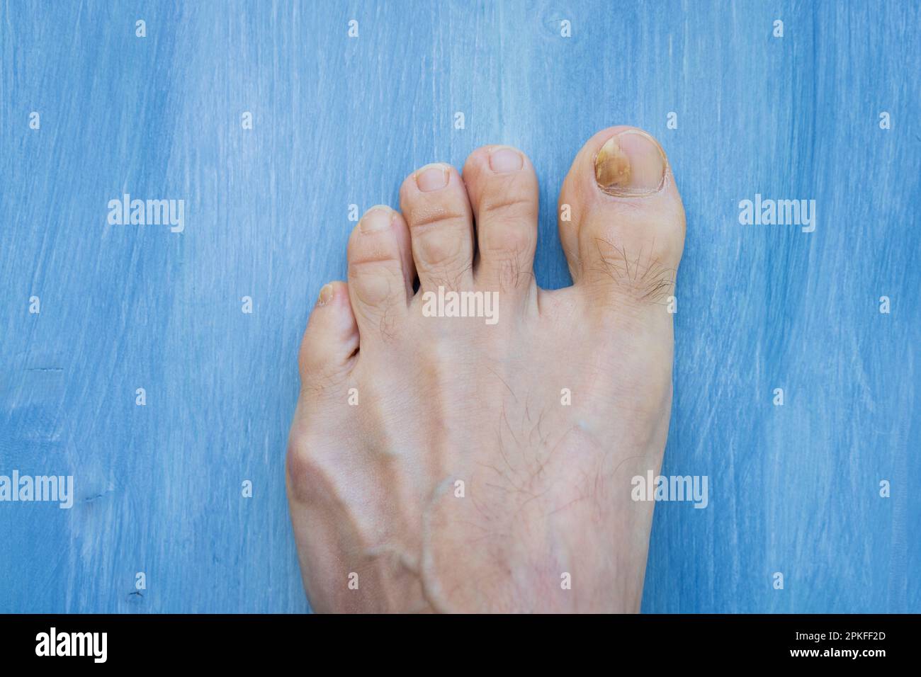 Toenails con problemi di fungo,Onychomicosis, anche noto come tinea unguium, è un'infezione fungina del chiodo, sfondo verde. Foto Stock