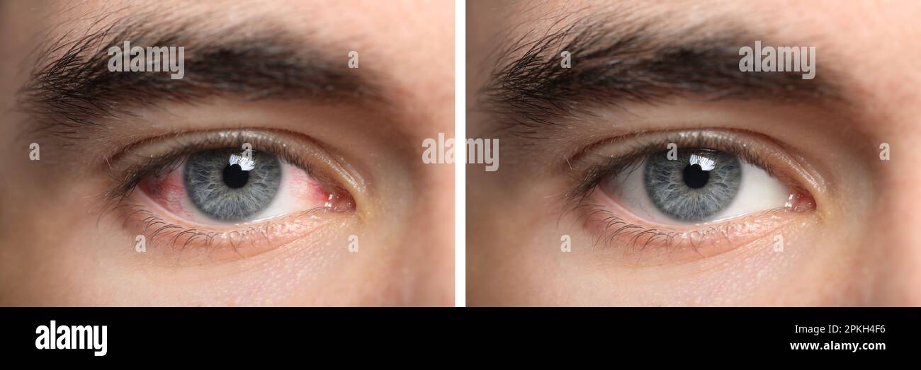 Collage con foto di uomo con occhi infiammati e sani prima e dopo il trattamento, primo piano. Design del banner Foto Stock