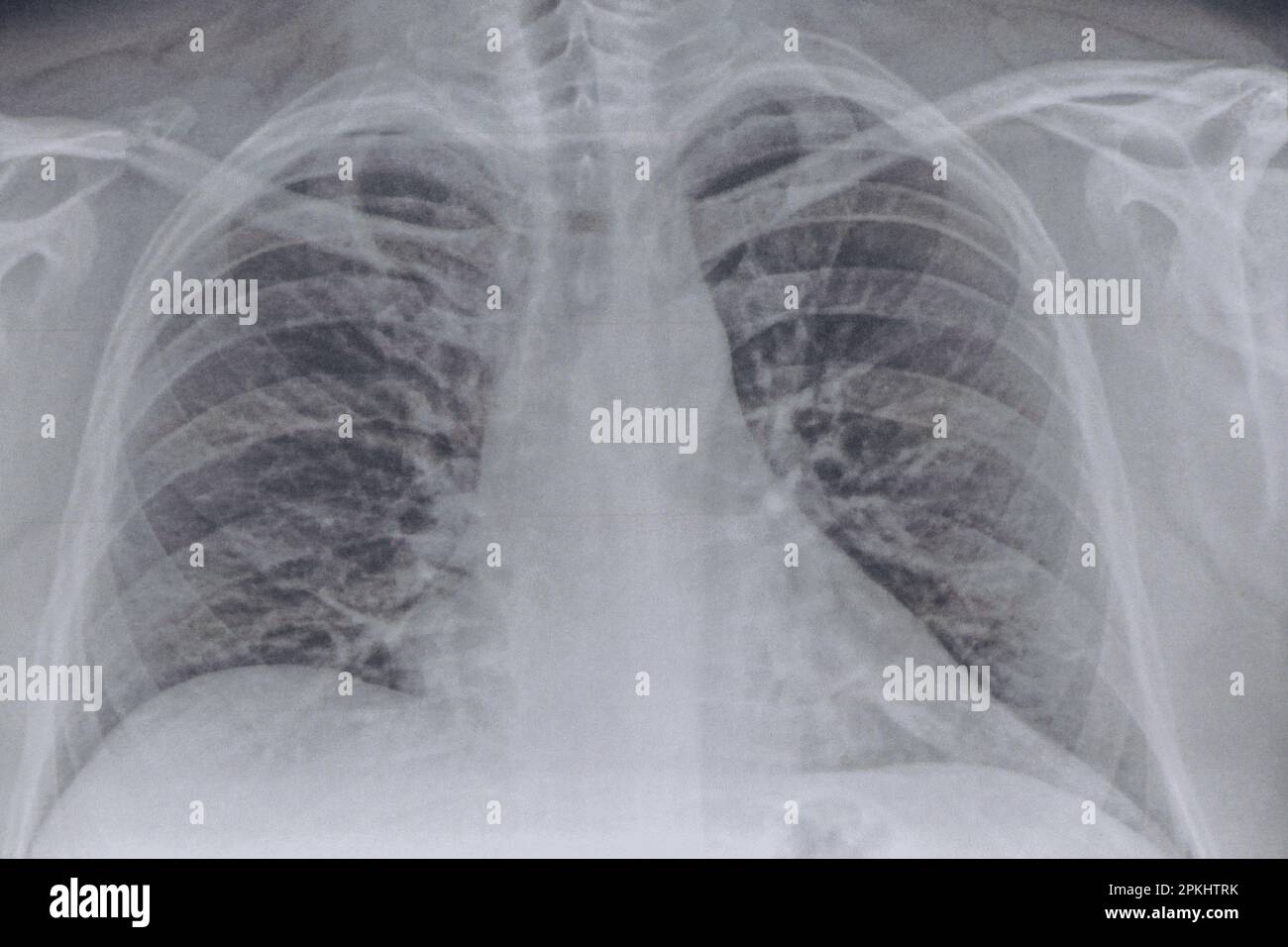 Immagine fluorografica dei polmoni su carta primo piano, polmoni sani di un uomo per un esame di routine, salute Foto Stock