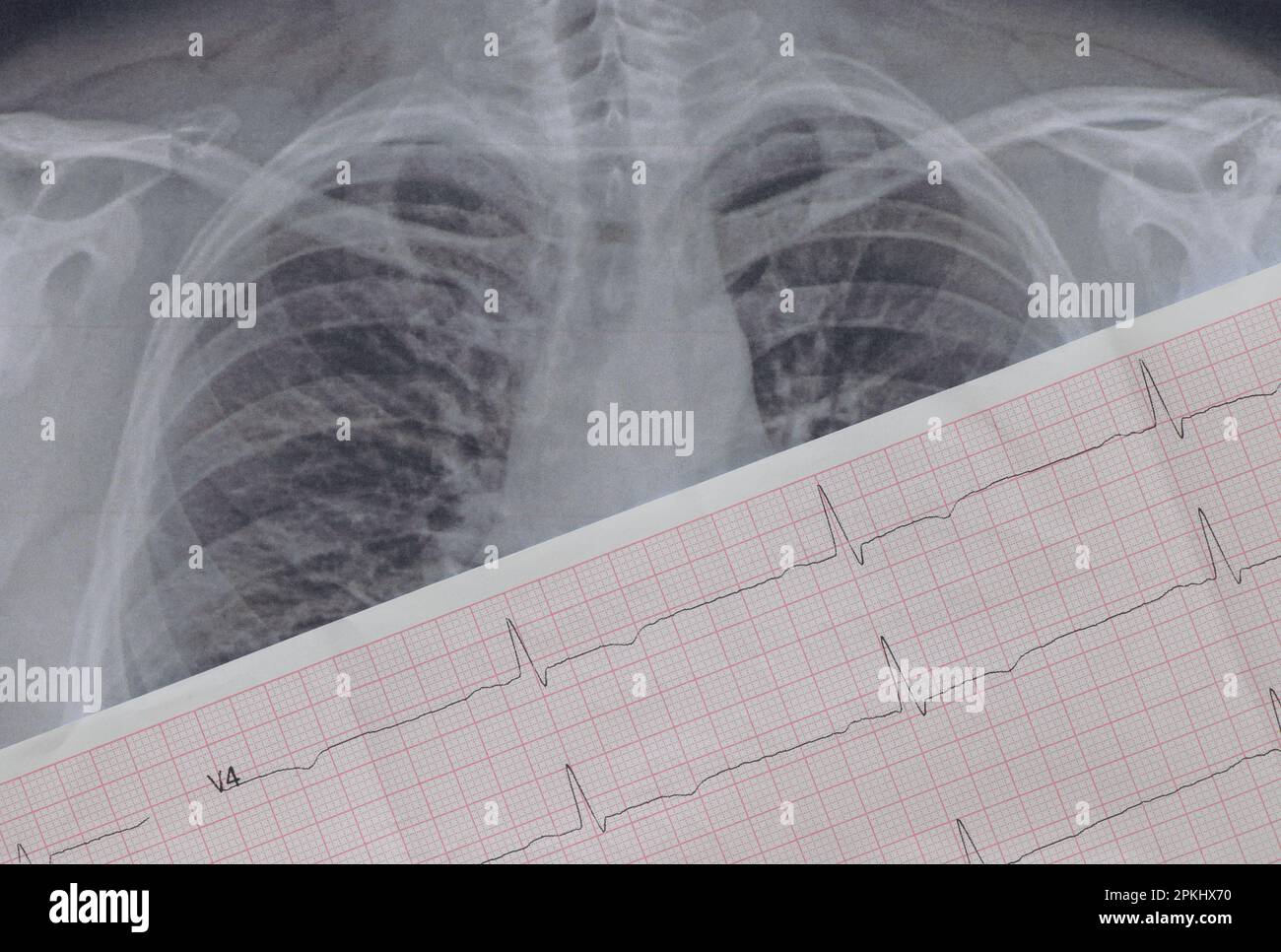 Immagine fluorografica dei polmoni su carta primo piano e un cardiogramma su carta, polmoni umani sani per un esame di routine Foto Stock