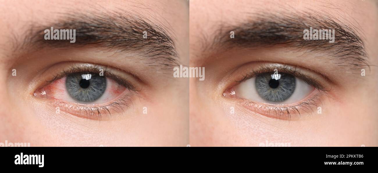 Collage con foto di uomo con occhi infiammati e sani prima e dopo il trattamento, primo piano. Design del banner Foto Stock