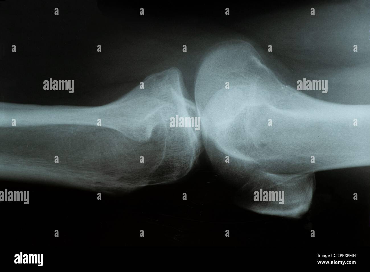 Radiografia di un paziente con un menisco lacerato dell'articolazione del ginocchio in un uomo e diagnosi Foto Stock