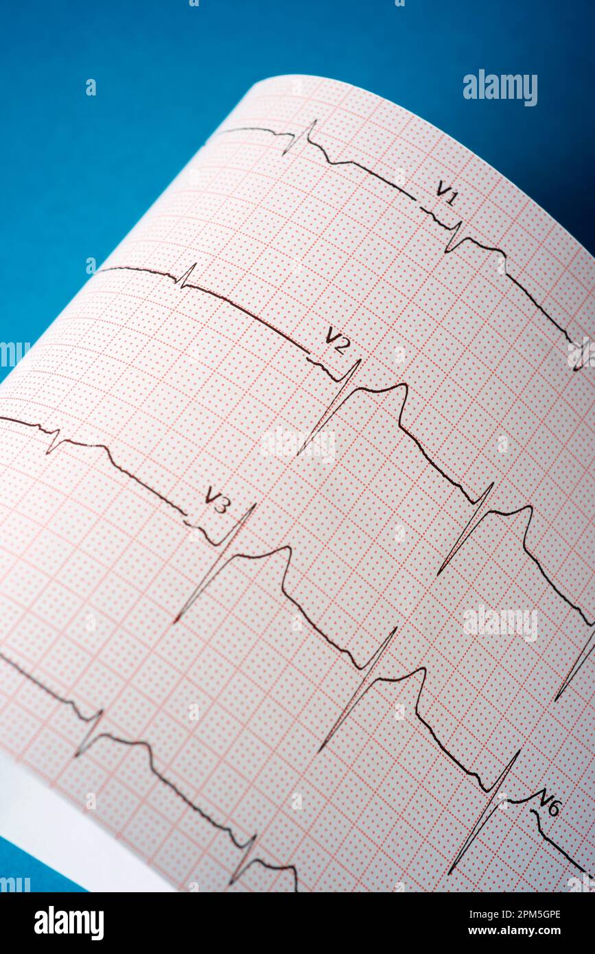 Elettrocardiogramma stampato su carta su un tavolo blu. Foto Stock